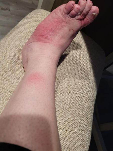 allergic foot 2.jpg